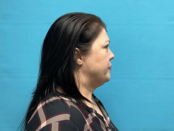Blepharoplasty Before & After