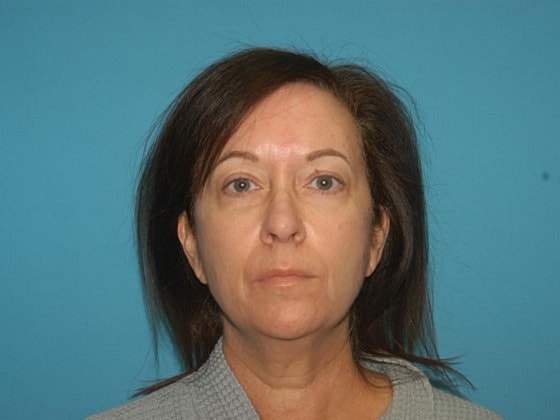 Blepharoplasty Before & After