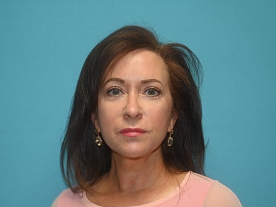 Blepharoplasty Before & After