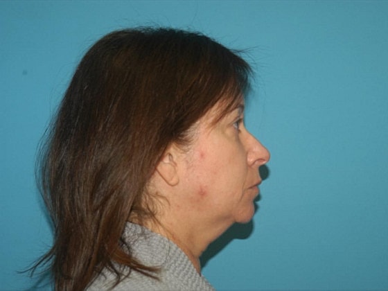 Blepharoplasty Before & After