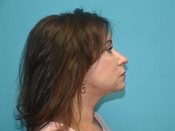 Blepharoplasty Before & After