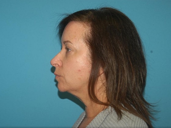 Blepharoplasty Before & After