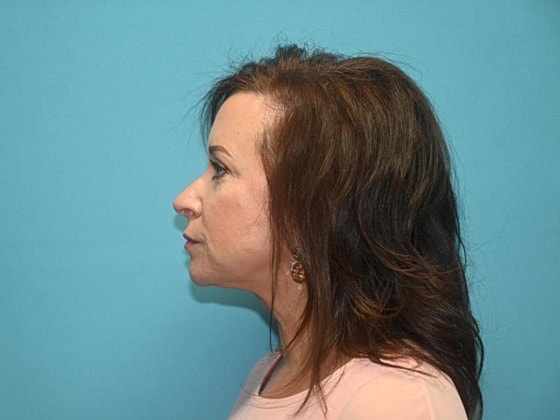 Blepharoplasty Before & After