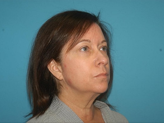 Blepharoplasty Before & After