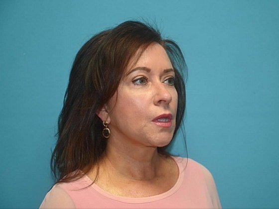 Blepharoplasty Before & After