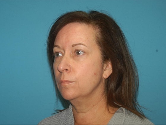 Blepharoplasty Before & After