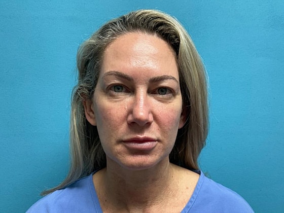 Blepharoplasty Before & After