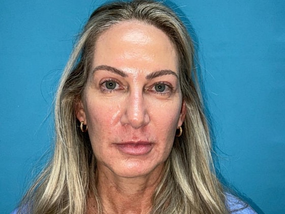 Blepharoplasty Before & After