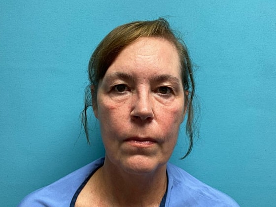 Blepharoplasty Before & After