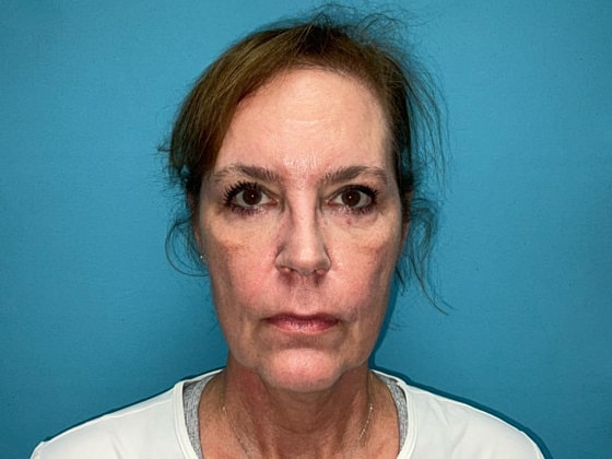 Blepharoplasty Before & After