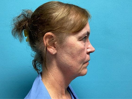 Blepharoplasty Before & After