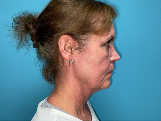 Blepharoplasty Before & After