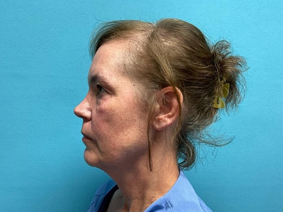 Blepharoplasty Before & After