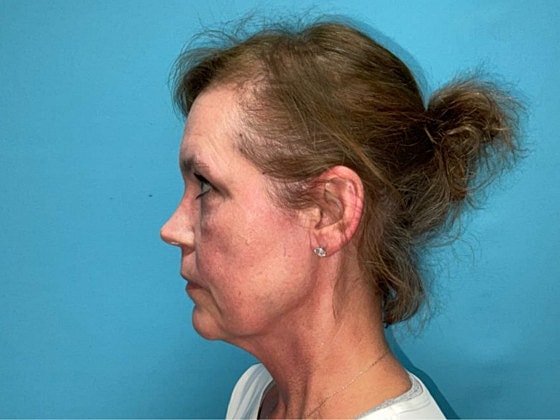 Blepharoplasty Before & After