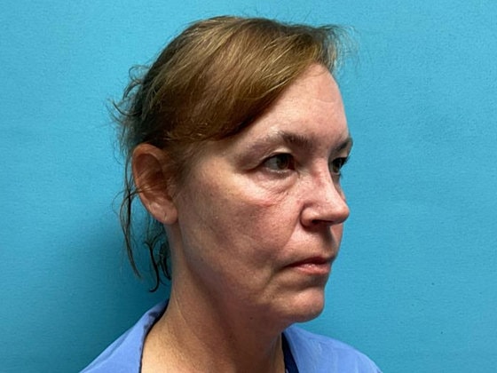 Blepharoplasty Before & After
