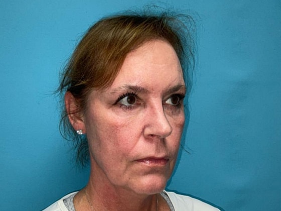 Blepharoplasty Before & After