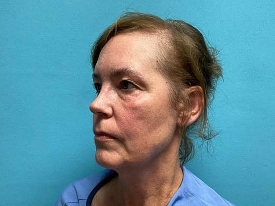 Blepharoplasty Before & After