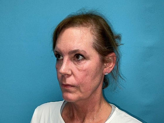 Blepharoplasty Before & After