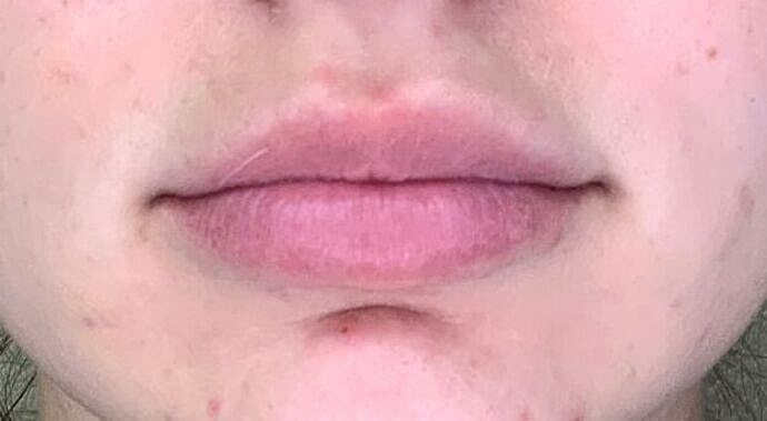 Dermal Filler Before & After