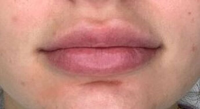 Dermal Filler Before & After