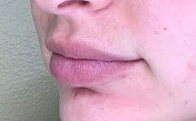 Dermal Filler Before & After