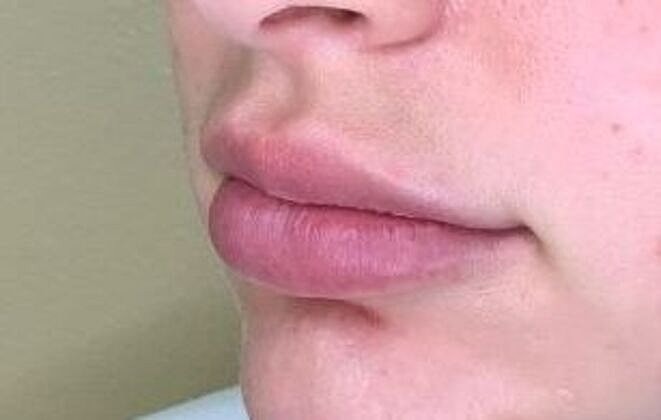 Dermal Filler Before & After