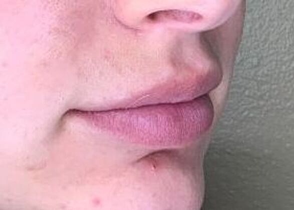 Dermal Filler Before & After