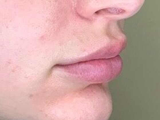 Dermal Filler Before & After