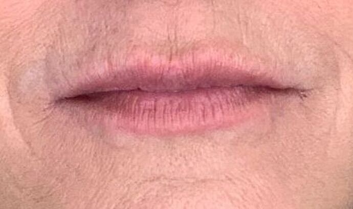 Dermal Filler Before & After