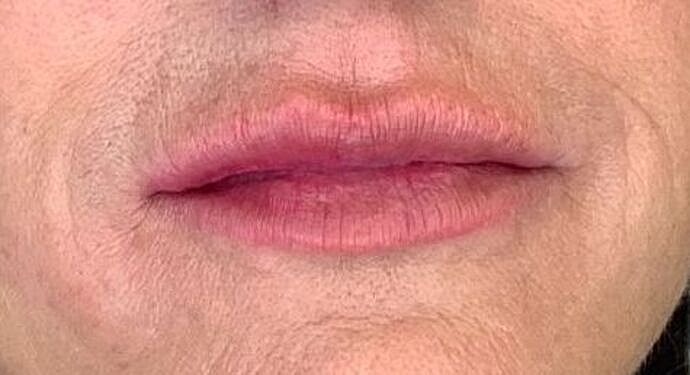 Dermal Filler Before & After