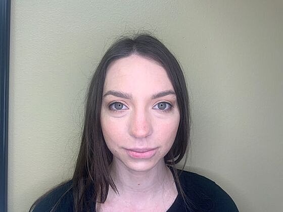 Dermal Filler Before & After