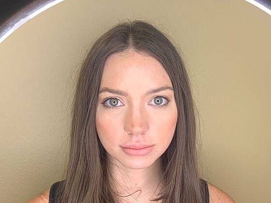 Dermal Filler Before & After