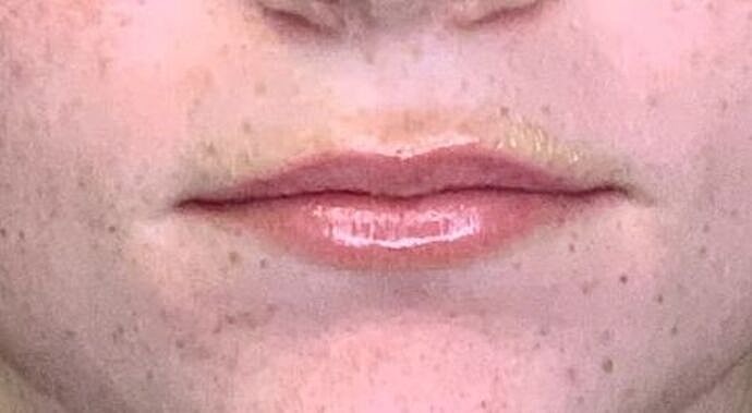 Dermal Filler Before & After