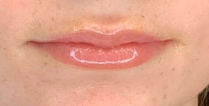 Dermal Filler Before & After