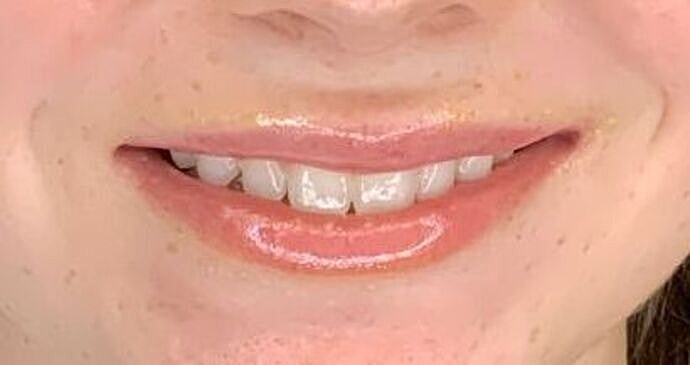 Dermal Filler Before & After