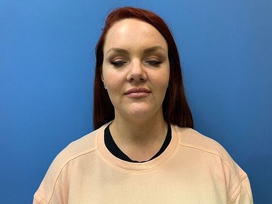 Dermal Filler Before & After