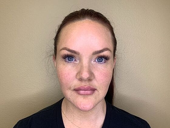 Dermal Filler Before & After