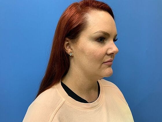 Dermal Filler Before & After