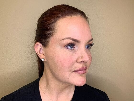 Dermal Filler Before & After