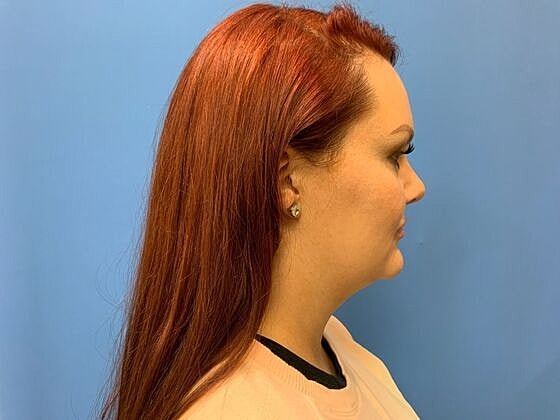 Dermal Filler Before & After