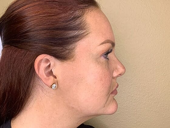 Dermal Filler Before & After