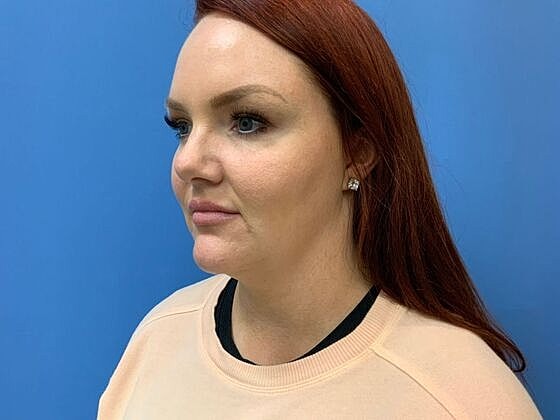 Dermal Filler Before & After