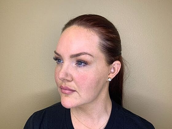 Dermal Filler Before & After