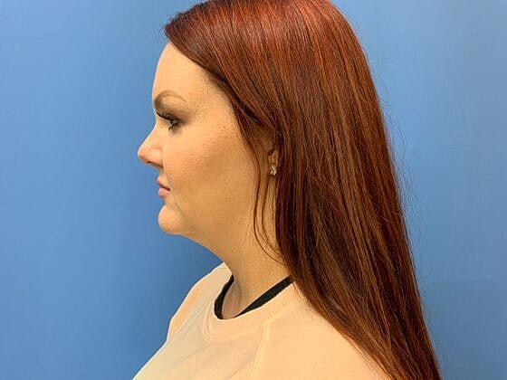 Dermal Filler Before & After