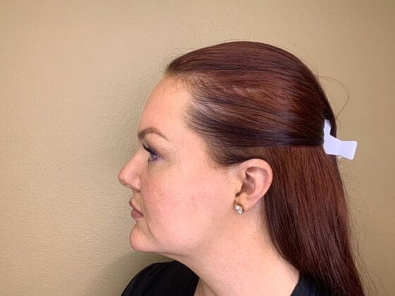 Dermal Filler Before & After