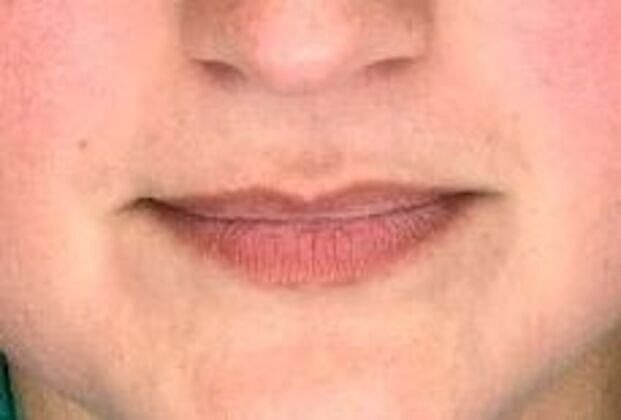 Dermal Filler Before & After
