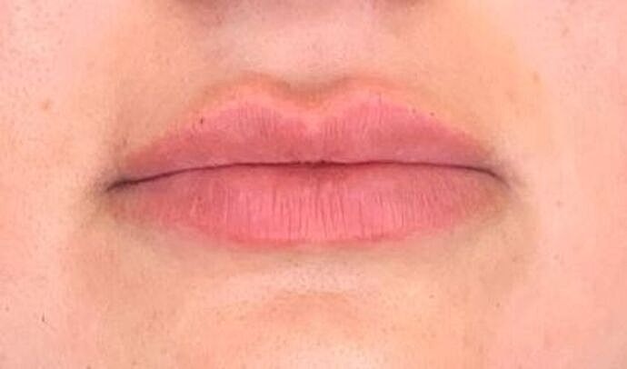 Dermal Filler Before & After