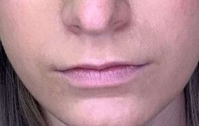Dermal Filler Before & After