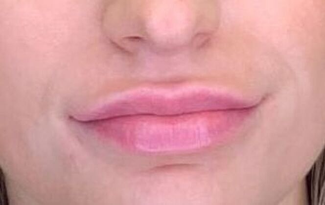 Dermal Filler Before & After
