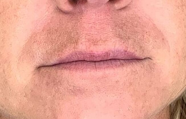 Dermal Filler Before & After